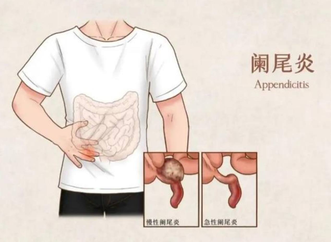 什么是阑尾炎？如何判断是否需要手术？(图1)