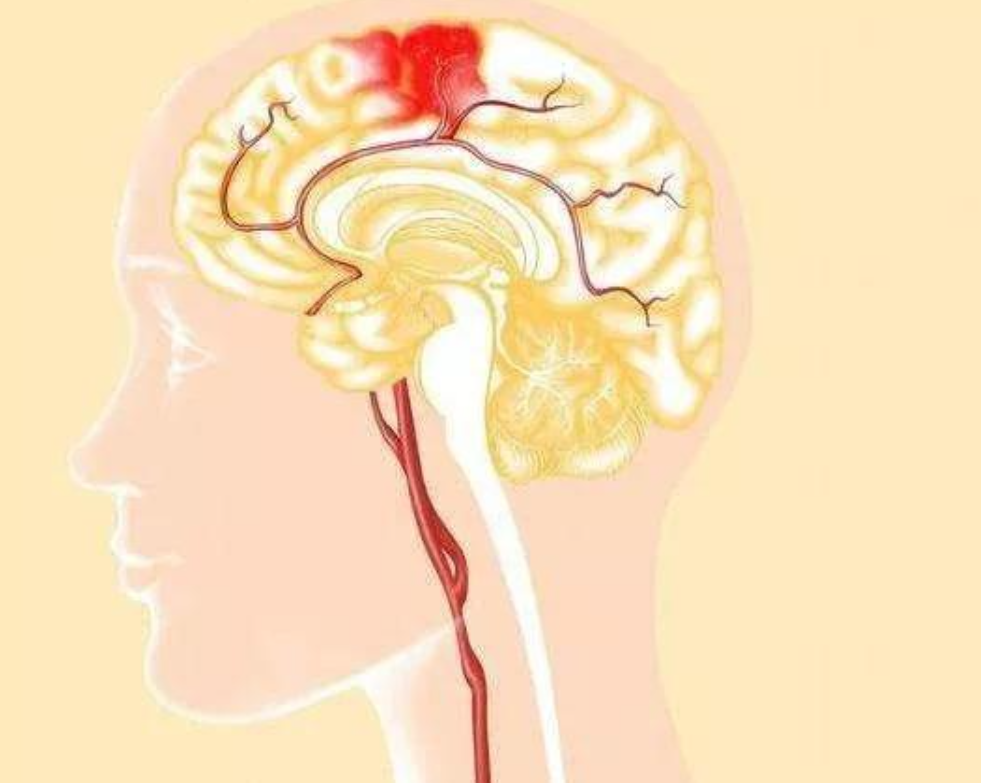 脑出血发生后应该怎么办？(图1)