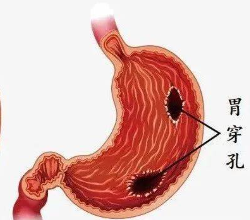 什么是胃穿孔？有哪些急救措施？(图1)