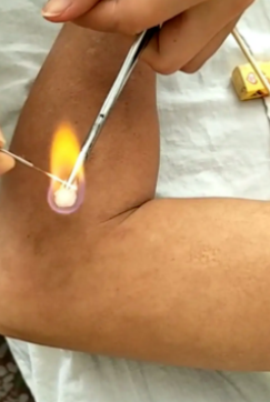 偏瘫康复之旅：火针治疗的“奇妙”体验(图3)