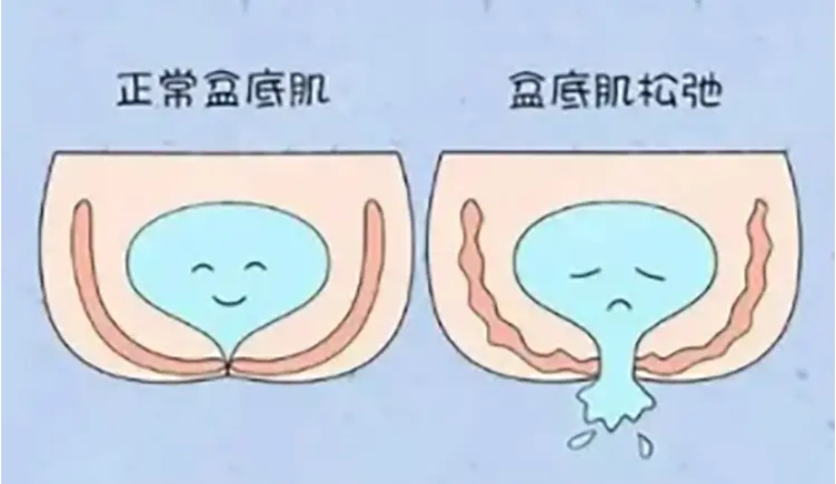 靓妈新生活：产后盆底肌修复的健康指南(图2)