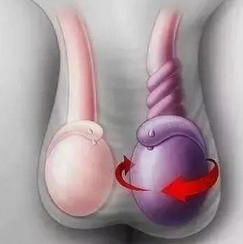 睾丸扭转的识别与处理(图1) 睾丸扭转的识别与处理(图1)