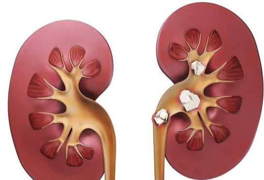 肾结石悄然而至 “石”你痛不欲生(图1) 肾结石悄然而至 “石”你痛不欲生(图1)