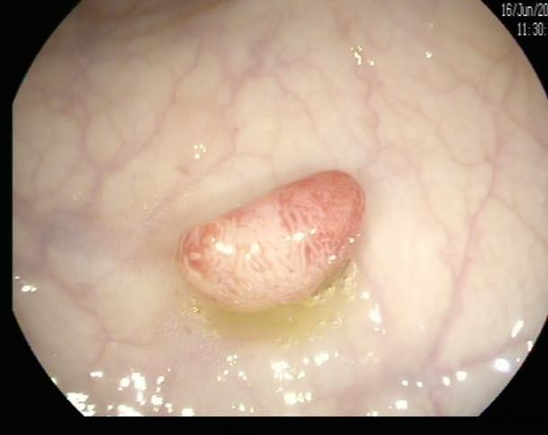 肠镜一照，息肉现形！形态各异的大肠息肉，离癌有多远？(图1)