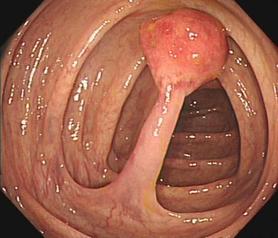 肠镜一照，息肉现形！形态各异的大肠息肉，离癌有多远？(图4)