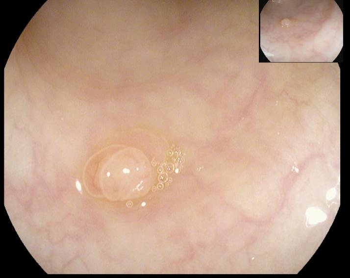 肠镜一照，息肉现形！形态各异的大肠息肉，离癌有多远？(图7)